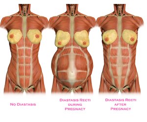 A legtöbb esetben az egyenes hasizom a szülés után eltávolodva marad -  a kérdés csak az, hogy mennyire...